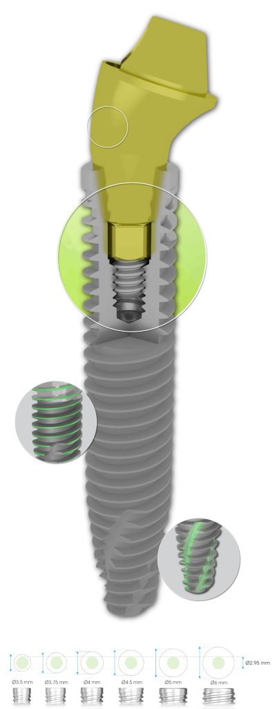 SP1 implant single platform